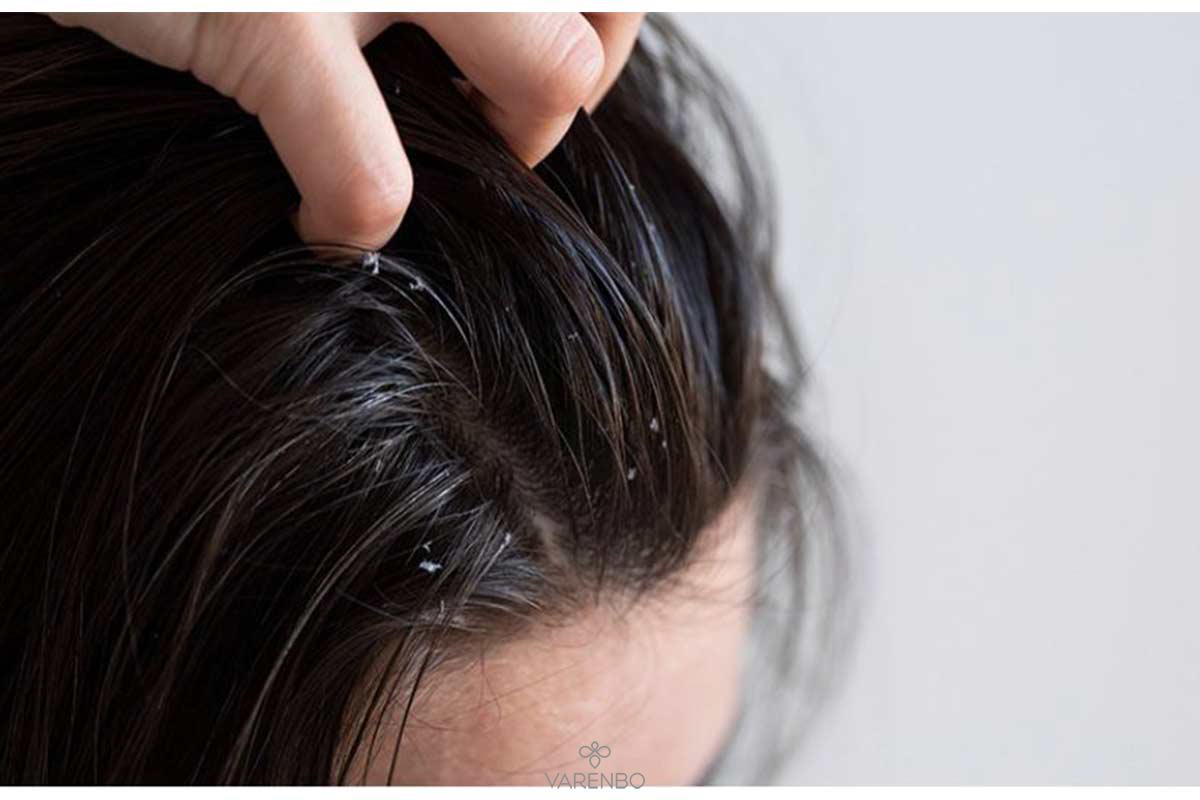 تفاوت شوره سر و خشکی پوست سر + روش درمان