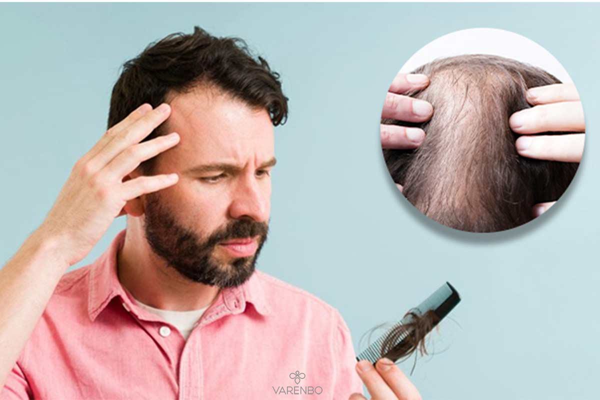 ریزش مو در جوانی؛ علل و بهترین روش درمان